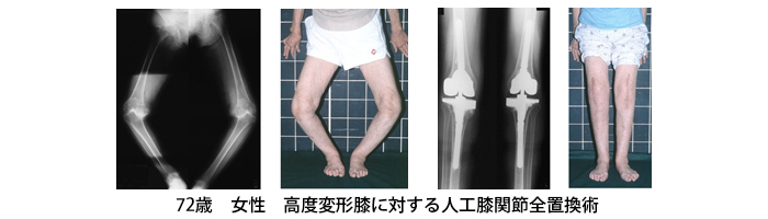 72歳　女性　高度変形膝に対する人工膝関節全置換術