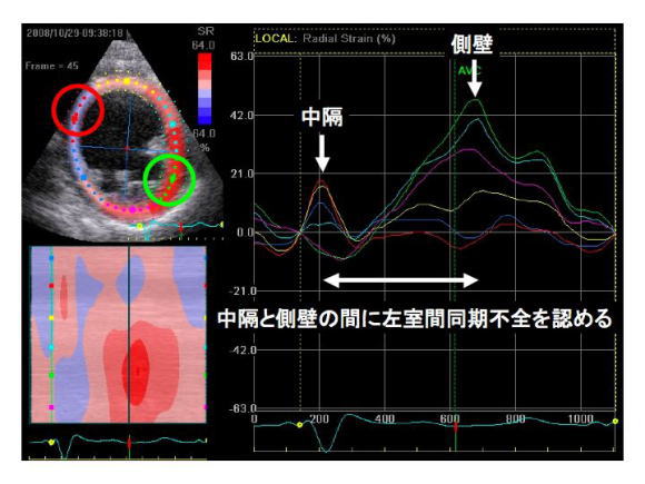 同症例のspeckle tracking像