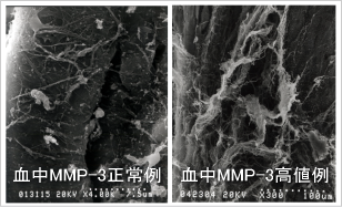 冠静脈洞内のMMP濃度