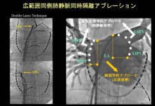 アブレーション