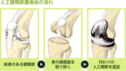 人工膝関節置換術の流れ