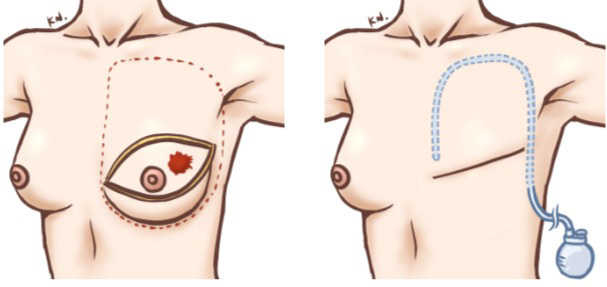 乳房全切除術（全摘術）