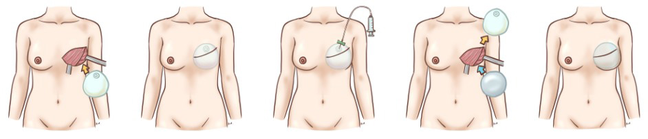 人工物を用いた乳房再建術