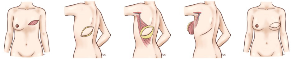 広背筋皮弁（自家組織）を用いた乳房再建術