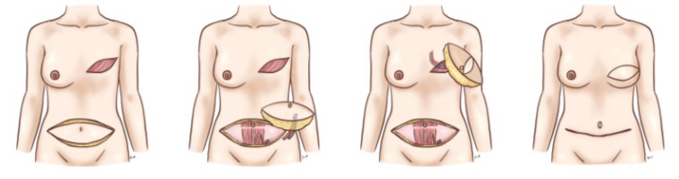 深下腹壁動脈穿通枝皮弁（自家組織）を用いた乳房再建術