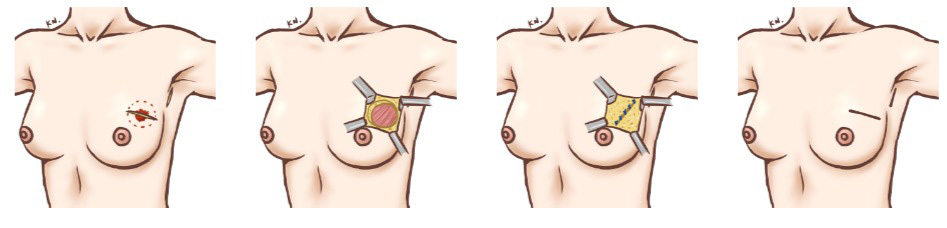 乳房部分切除術（温存術）