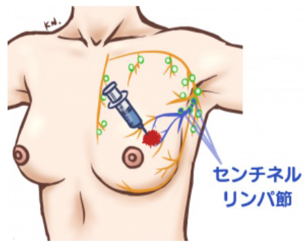 センチネルリンパ節の同定方法（色素法）