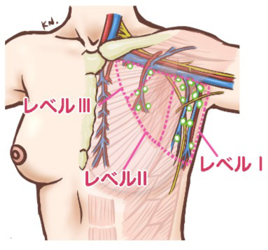 腋窩リンパ節郭清の範囲