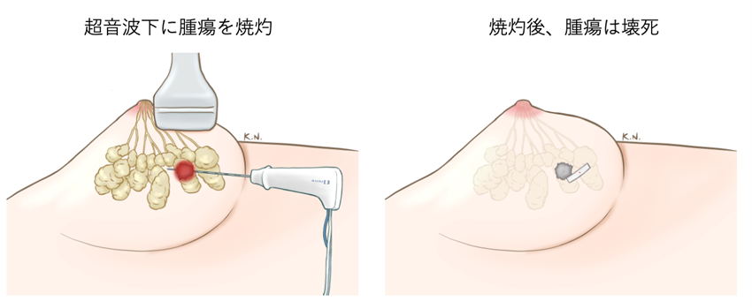 ラジオ波焼灼療法(RFA)