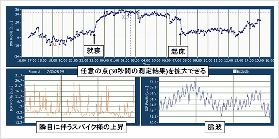 図1. CL型眼圧計による眼圧日内変動の測定