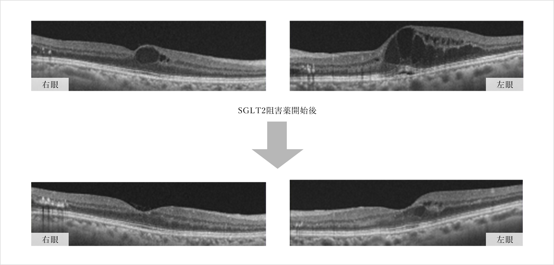 画像：糖尿病黄斑浮腫に対するSGLT2阻害薬の効果