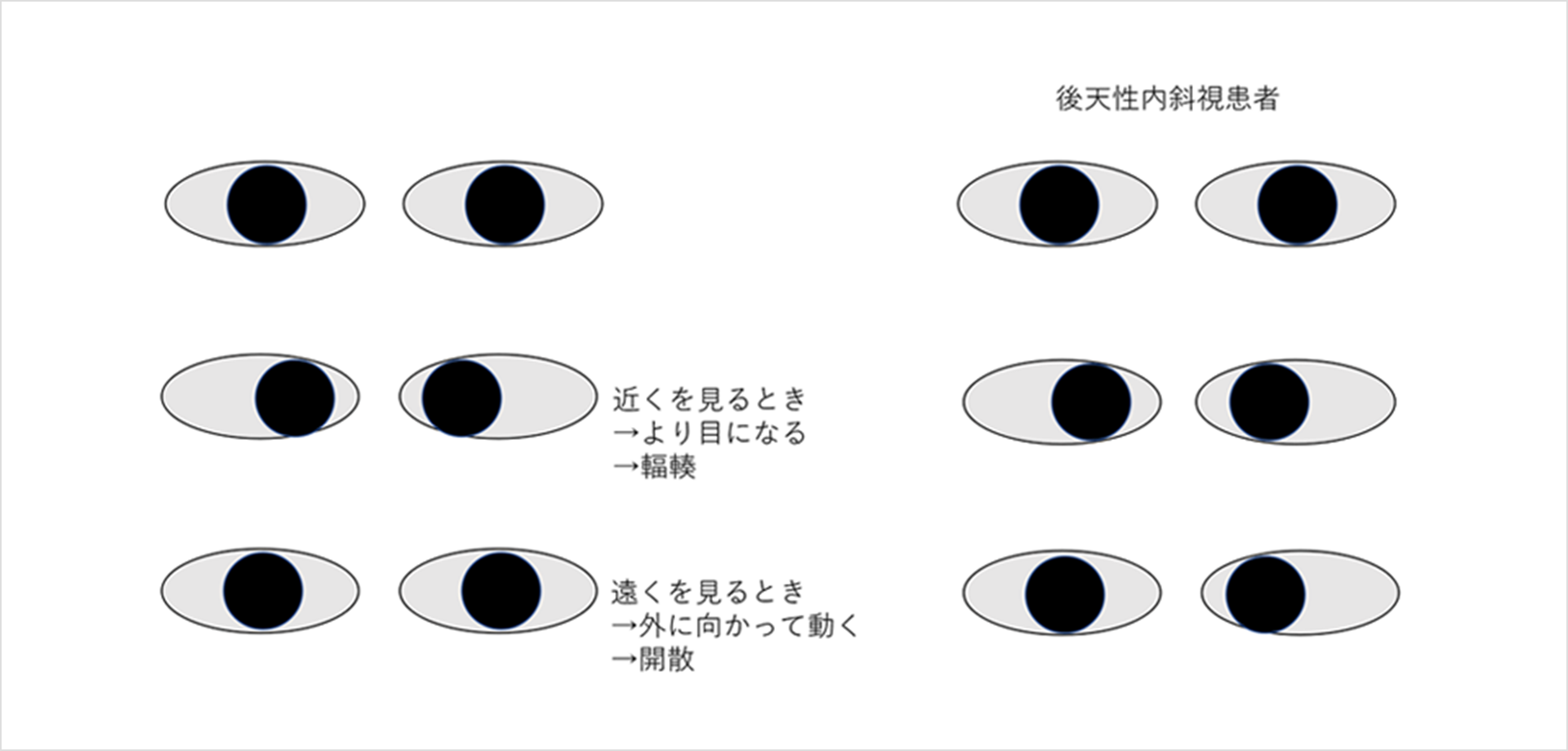 画像：内斜視発症の機序(仮説)