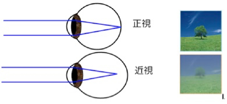 イメージ：近視