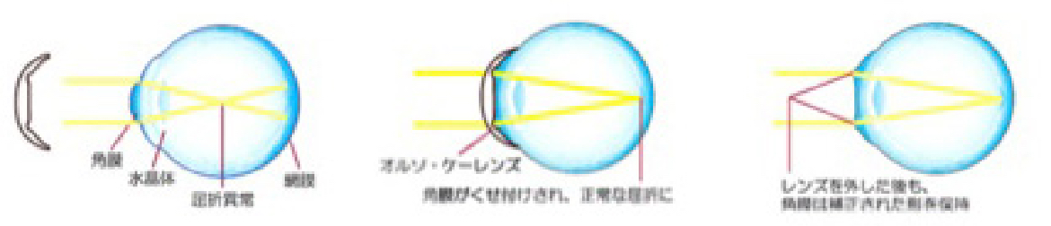 図：オルソケラトロジーの仕組み