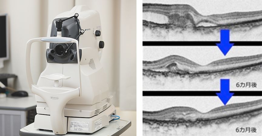 イメージ：OCT-2000 (TOPCON)でみる加齢黄斑変性の治療経過