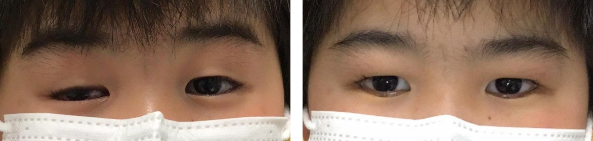 イメージ：両先天性下眼瞼睫毛内反症術前後