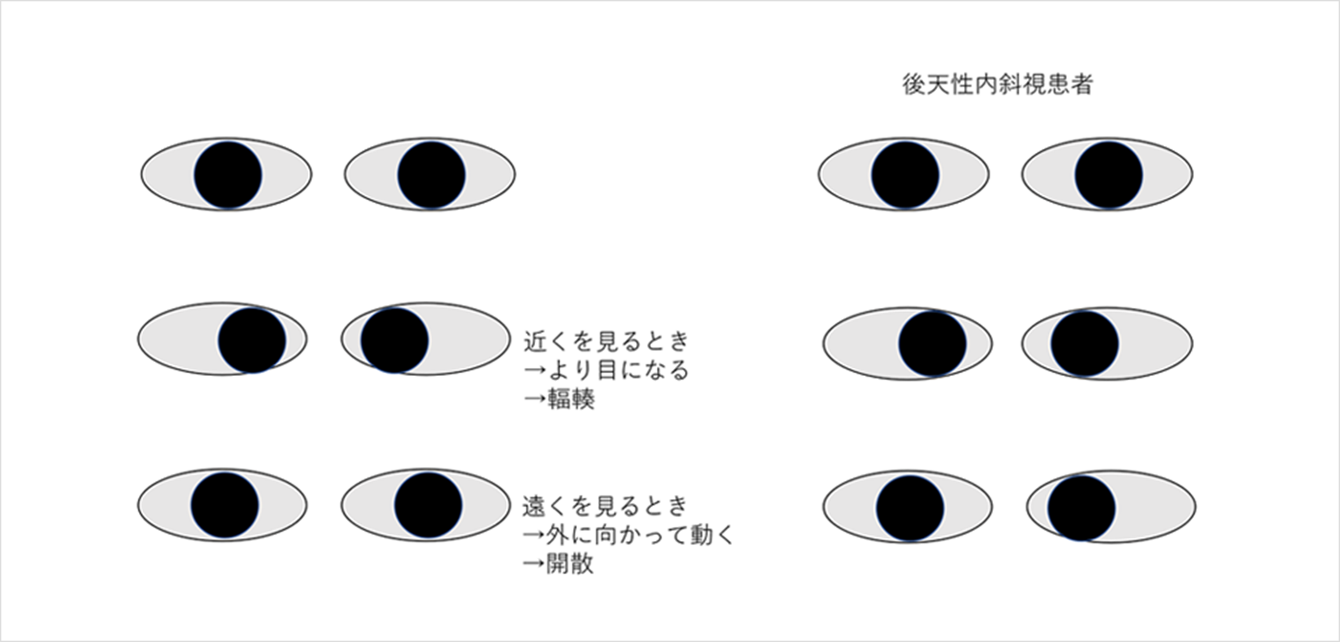 図1. 内斜視発症の機序(仮説)