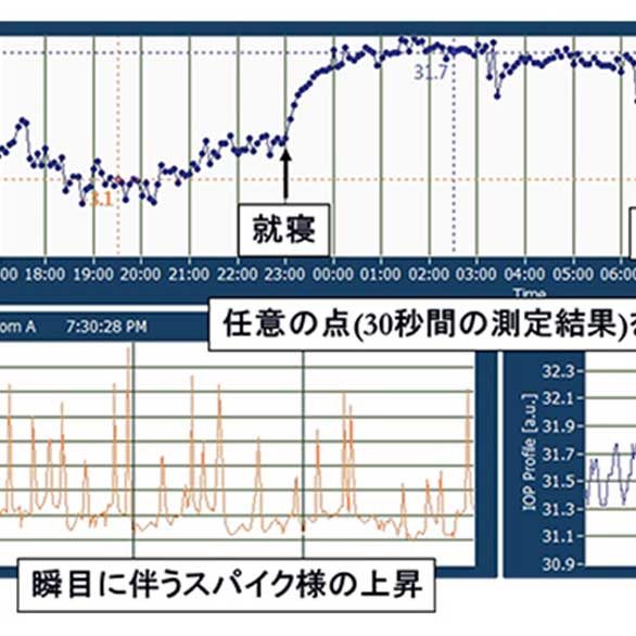 緑内障