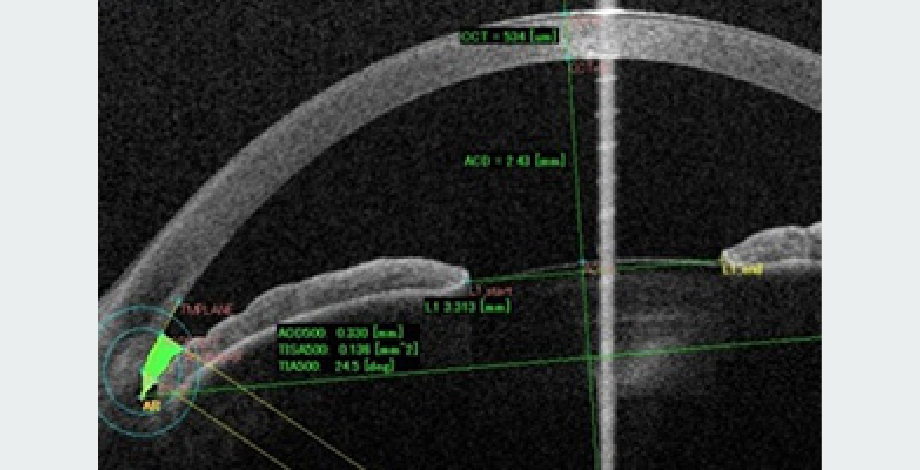 前房、隅角解析例