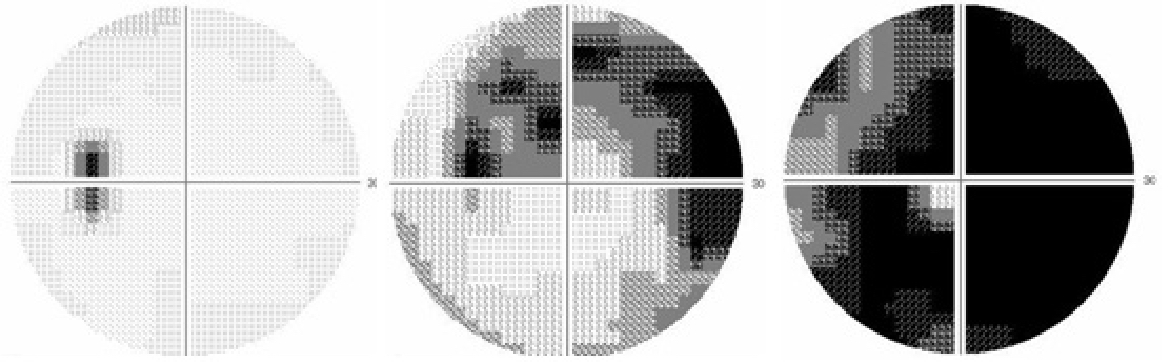 ハンフリー視野検査