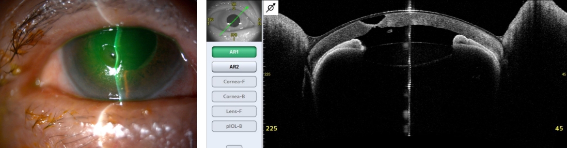涙道閉塞により角膜穿孔に至った症例