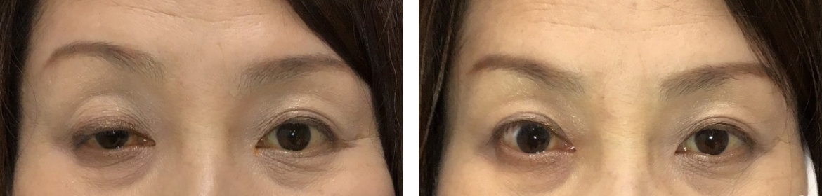 右上眼瞼下垂術前後