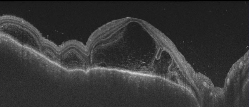 光干渉断層計の画像（フォークト・小柳・原田病）