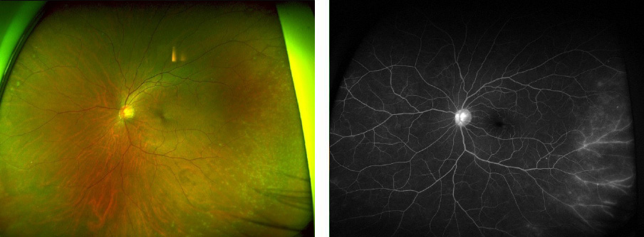 広角眼底カメラと蛍光眼底造影検査の画像（サルコイドーシス）