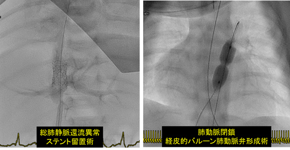 カテーテル治療