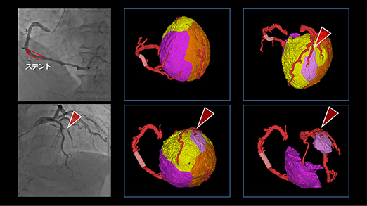 イメージ：ボロノイ図を利用した心臓CTによる冠動脈の支配領域の定量評価