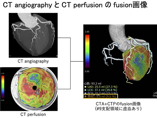 イメージ：CT angiographyとCT perfusionのfusion画像による心筋虚血部位と冠動脈支配域の明瞭化