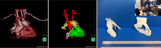 イメージ：心臓CTから3Dプリンタを使用して、3D心血管モデル（血液プールモデル、中腔モデル）を作成した例