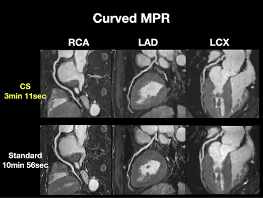 イメージ：Compressed sensingを用いた高速冠動脈MRA撮像 (SIEMENSとの共同研究）