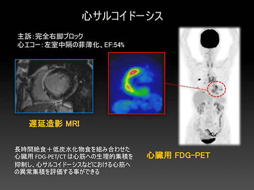 イメージ：長時間絶食プロトコールを用いた心臓用FDG-PET/CTの臨床研究