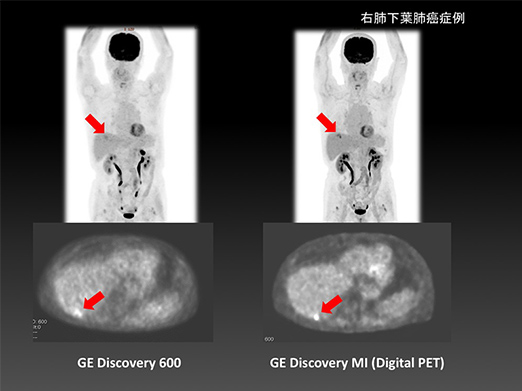 イメージ：半導体デジタルPET/CTと旧PETとの比較研究