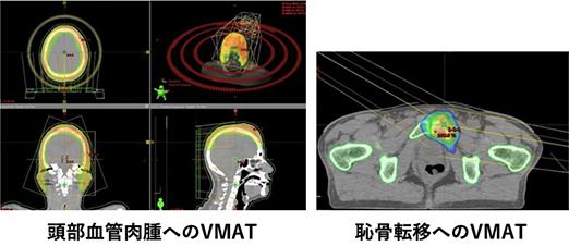 イメージ：強度変調放射線治療(IMRT)の適応拡大