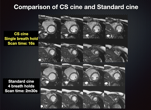イメージ：Compressed sensingを用いた高速cine MRI撮像 (SIEMENSとの共同研究)