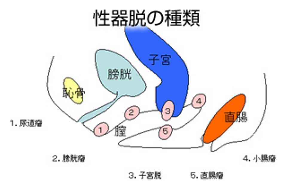 骨盤臓器脱 - 愛媛大学医学部 泌尿器科学