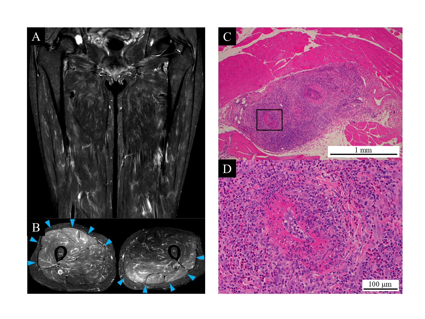 テゼペルマブ投与中に発症した好酸球性多発血管炎性肉芽腫症の一例