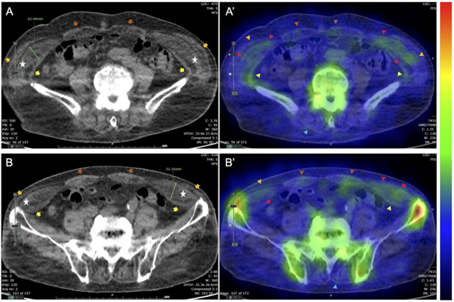 野生型トランスサイレチン心アミロイドーシス患者の骨格筋障害